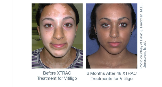 Before and After XTRAC Treatments